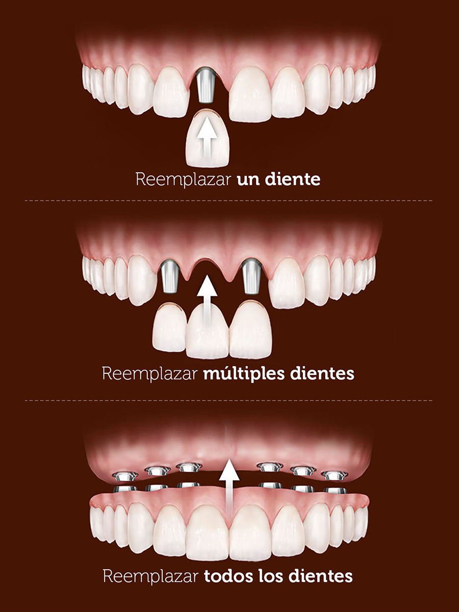 Implantes Dentales