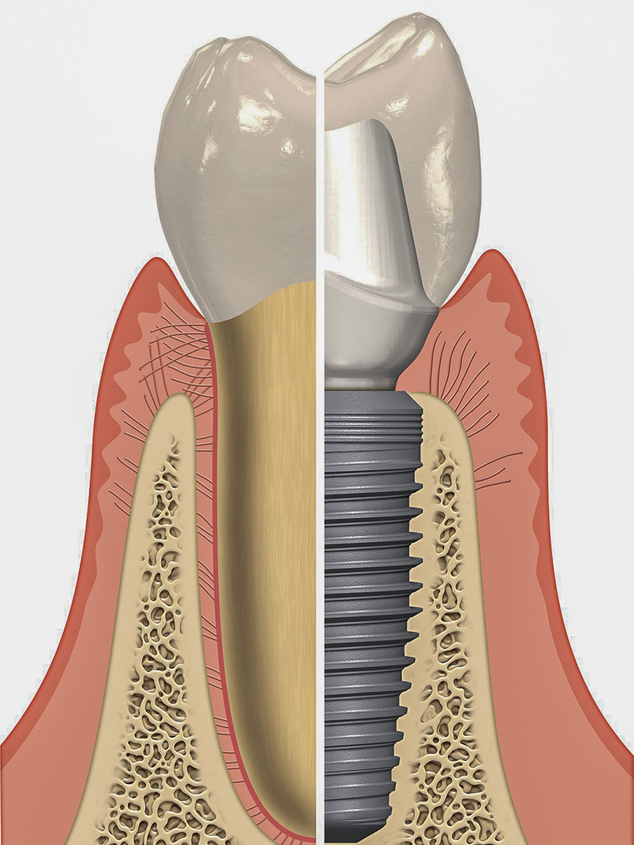 Implantes Dentales